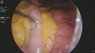 Laparoscopic Roux en Y Gastric Bypass-DOSS clinic