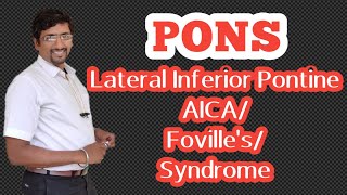 Pons (Part - 6) Lateral inferior pontine syndrome/ AICA syndrome/ Foville's syndrome