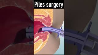 3d animation of Piles rubber band surgery #shorts