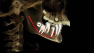 Dynamic 3D Mandibular Superimposition - Bjork Style