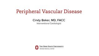 Peripheral vascular disease treatment | Ohio State Medical Center