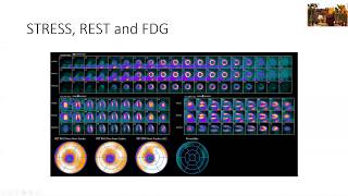 Step by Step Reading of a Cardiac PET for Scar Detection