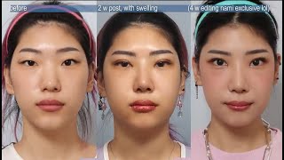 [EP. 2 NAMEE'S PLASTIC SURGERY JOURNEY] 2 Weeks Post-op Review! #plasticsurgery #banobagi