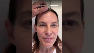 7 days update from endoscopic browlift and upper blepharoplasty