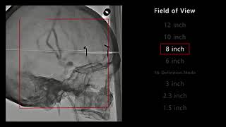 Alphenix Angiography Canon Medical Systems USA 1