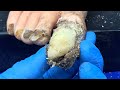 Pedicure Tutorial: Dirt hides under the ingrown, Curved fungus in toenails 1352