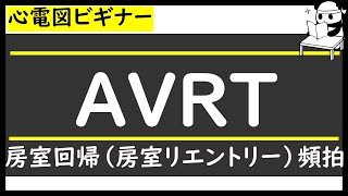 心電図　AVRT【房室リエントリー（房室回帰）性頻拍】【PSVT】　ゼロから心電図検定4級3級