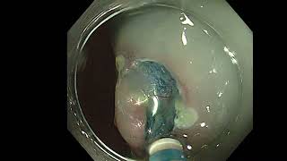 colon ESD (rectum NET)