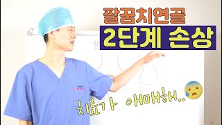 팔꿈치연골손상 시리즈 5 - 팔꿈치연골손상 단계에 따른 치료방법