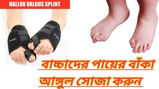 বাচ্চা ও বড়দের পায়ের আঙ্গুল সোজা করার Hallux valgus।Baby food pain remove, Hallux valgus splits.