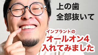 【インプラント】上の歯ぜんぶ抜いてオールオンフォーを入れてみました【体験】