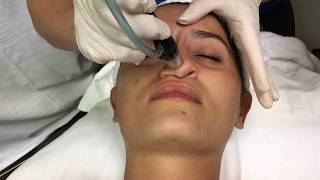 Silk Peel Dermal Infusion Facial