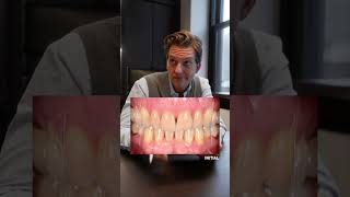 She had BRACES for YEARS and was left with this - SMILE MAKEOVER