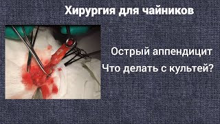 Хирургия для чайников. Острый аппендицит. Что делать с культёй?