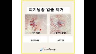 피지낭종 주머니 압출//sebocystoma extraction without pain, surgery and scar/ 皮脂囊肿没有手术挤压排除//