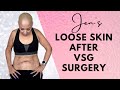 QUALITY OF LIFE with LOOSE SKIN AFTER VSG SURGERY