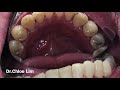 insanely satisfying dental scaling in 5 minutes