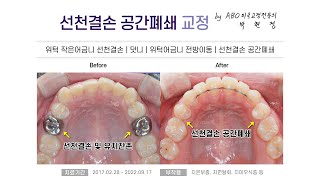 [선천결손 공간모으기 부산 뉴욕스마일치과] 선천결손 공간폐쇄 교정(위턱 작은어금니 선천결손/덧니/위턱어금니 전방이동/선천결손 공간폐쇄) B\u0026A