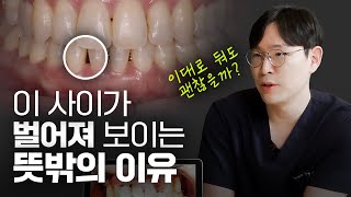 블랙트라이앵글의 원인과 치료방법ㅣ당신의 이 사이가 벌어진 진짜 이유 알려드립니다❗️