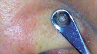 毛穴の脂押し出し抜く、Whiteheads blackheads 【閲覧注意】