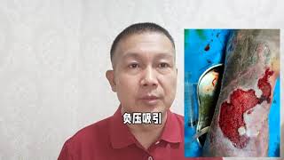 how to treat the venous ulcers? 如何治疗下肢老烂腿（静脉溃疡）？