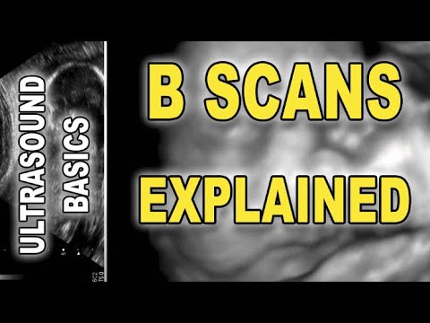 Ultrasound/sonogram - B Scans Explained - YouTube