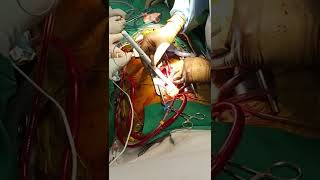 Epicardial pacing lead insertion