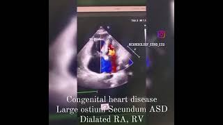 Echocardiography (2D echo, heart scan learning video..