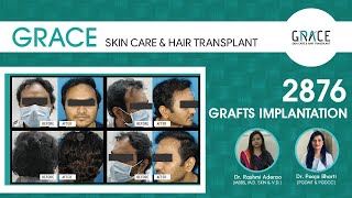 Best high-density hair transplant in 6 months| 6 महिन्यांत सर्वोत्तम उच्च घनतेचे केस प्रत्यारोपण