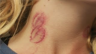 easy trick to make a fake hickey at home