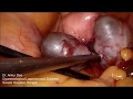 Twin Big Chocolate Cyst removed by laparoscopic operation - Dr. Ankur Das, Swasti Hospital, Rangia