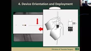 How I do It: Fenestrated EVAR with Dr. Wes Jones and Dr. Murray Shames from USF