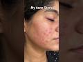 My Acne Story 🫶🏻 #youtubeshorts #clinicalcosmetologist