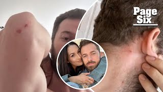 Artem Chigvintsev claims estranged wife Nikki Garcia was the abuser, shows off bloody scratches