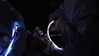 Laparoscopic Nissen Fundoplication Surgery