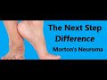 The Next Step Difference:  Morton's Neuroma