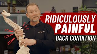 Lumbar Radiculopathy = Ridiculously Painful! | Health Matters