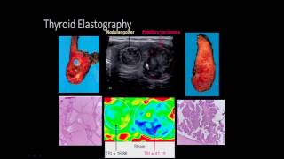 Thyroid Elastography