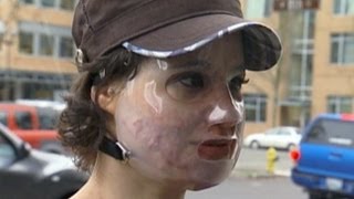 Acid Attack Hoax: Bethany Storro Admits Lie, Says She Suffered From Mental Illness