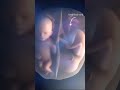 Twins fight in mother womb| #shorts