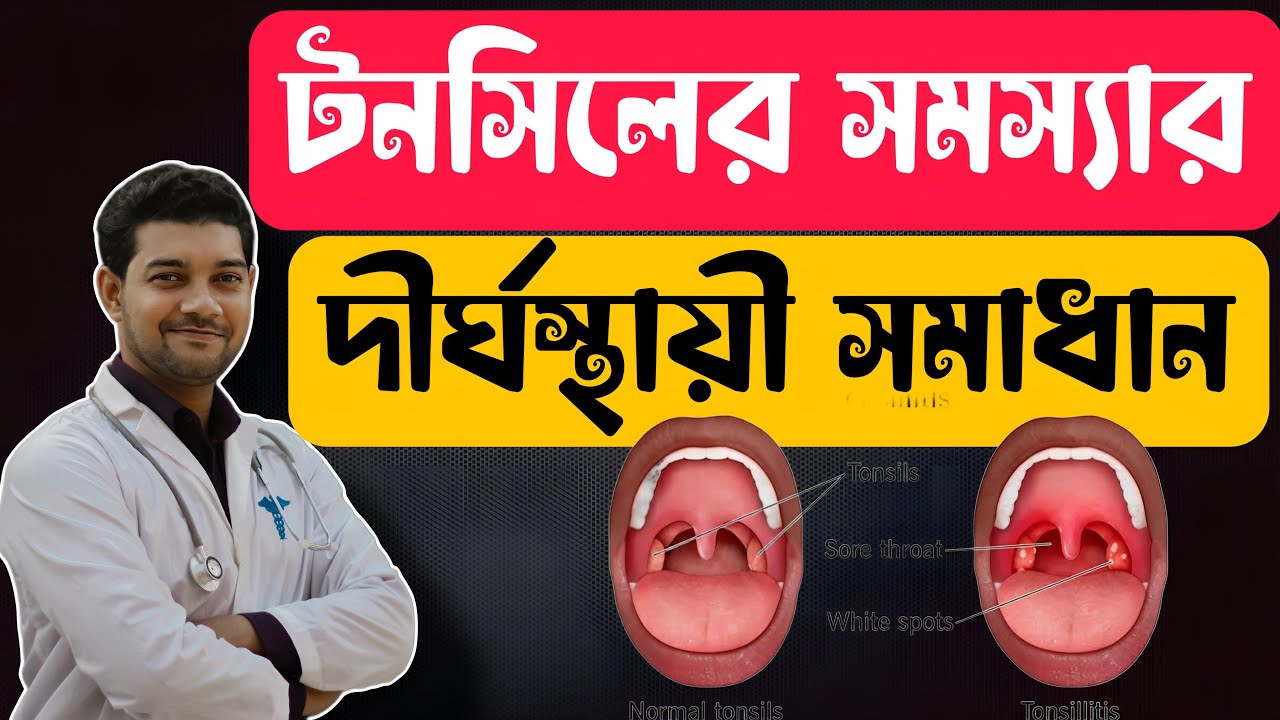 টনসিলের সমস্যা ও সমাধান | Tonsillitis Treatment| - YouTube