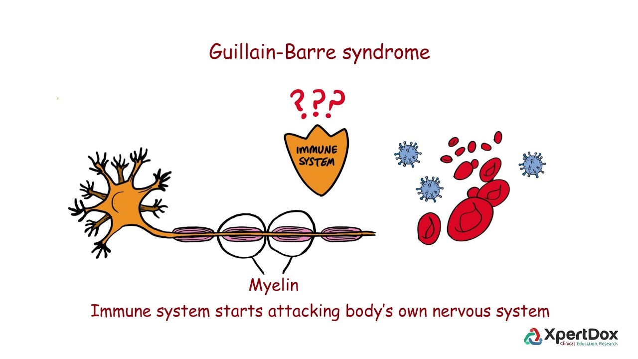 Guillain-Barré Syndrome ~ Learn About Guillain Barre Syndrome With A ...