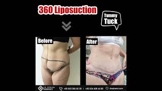 Tummy Tuck + 360 Liposuction | Op. Dr. Serkan Sabancı | Plastik Rekonstrüktif ve Estetik Cerrahi