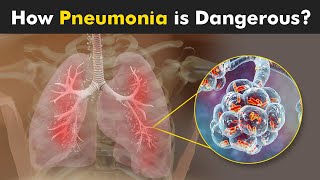 What Happens in Pneumonia? | Symptoms, Causes and Treatment (3D Animattion)