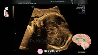 Fetal corpus callosum. How this brain part is seen and measured. Pericallosal arteries also shown.