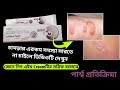 Ludura Soft Cream | Luliconazole 1% Cream use in Bangla | Ludura Soft skin cream how to use