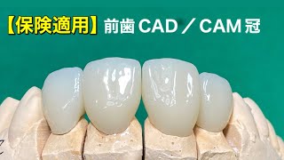 【歯科技工】保険でできる白い歯ハイブリットセラミック前歯4本の「CAD／CAM冠」歯科技工士作業動画（exocad3.0ソフト）