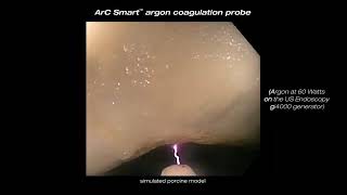 Arc Smart™ Argon Coagulation Probe - Clinical Video