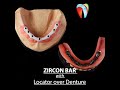 Zircon  or  Metal Bar?  Available  @  Qualident Dental Lab