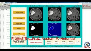 Brain Tumor Detection Using Watershed Algorithm With Source Code | Brain Tumor Detection Matlab Code